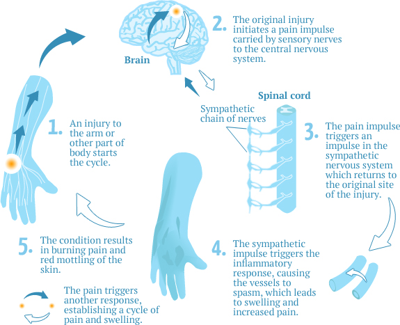 CRPS Diagram